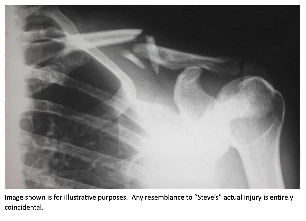 Black-and-white X-ray image showing a fractured collarbone near the shoulder joint, with separated bone fragments visible. Caption beneath the image humorously states: ‘Image shown is for illustrative purposes. Any resemblance to “Steve’s” actual injury is entirely coincidental.